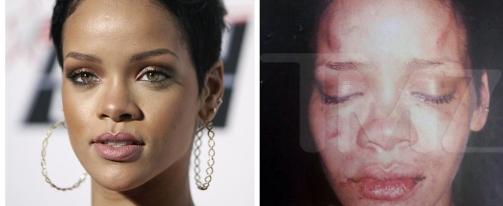 MISHANDLET: Bilder av en blodig og forsl�tt Rihanna etter Chris Brown-angrepet ble publisert av nettstedet TMZ. Foto: AP Photo/Matt Sayles/TMZ