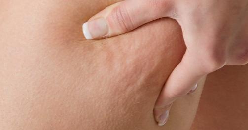 FETT: Cellulitter dannes av fett i det innerste hudlaget. FOTO: crestock.com