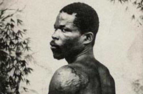 ENESTE OVERLEVENDE: Mellom 30 000 og 40 000 ansl�s � ha d�dd i vulkanutbruddet p� Martinique i 1902. August Cyparis (han er kjent under flere navn) var den eneste overlevende, if�lge mange kilder. Her er han avbildet med brannskadene han fikk. Foto: WIKIMEDIA