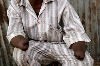 BRUTALT: Tamba Gowdja fikk hendene hugget av i 1998 av soldater fra den beryktede RUF-geriljaen under Sierra Leones brutale borgerkrig. Flere enn 6000 fikk amputert kroppsdeler under terrorkampanjen.  Foto: EPA/NIC BOTHMA/SCANPIX