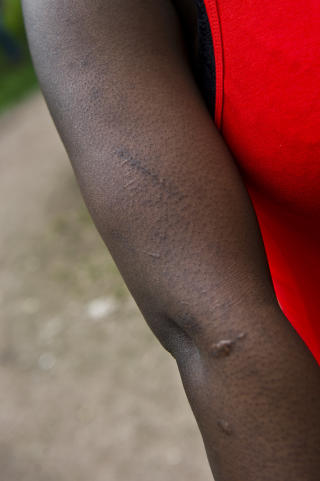 AVSTRAFFELSE: - Jeg fikk disse merkene p� armen da halliken slo meg til blods med et belte fordi jeg ba om � f� slippe � g� p� gaten �n kveld jeg hadde sterke magesmerter, forteller kvinnen (25) fra Nigeria. Foto: H�kon Eikesdal/Dagbladet