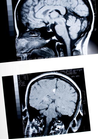 LANGVARIG MISBRUK KAN GI NEVROBIOLOGISKE ENDRINGER: Hjerneforandrigene kan f�re til at det er lettere � oppta misbruket igjen etter at man har v�rt gjennom avrusning. Foto: 
Foto: Linda N�sfeldt