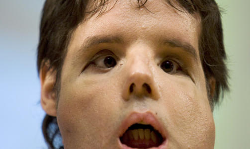  24 TIMER: Operasjonen av Oscar tok et d�gn.FOTO: AFP PHOTO / HANDOUT VALL D'HEBRON HOSPITAL