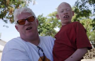 JOBBER FOR ALBINOER: Peter Ash fra Canada som selv har albinisme, har dannet foreningen Under The Same Sun, som skal hjelpe albinoer over hele verden. Her er han i Tanzania i novemer 2009. FOTO: REUTERS/Katrina Manson