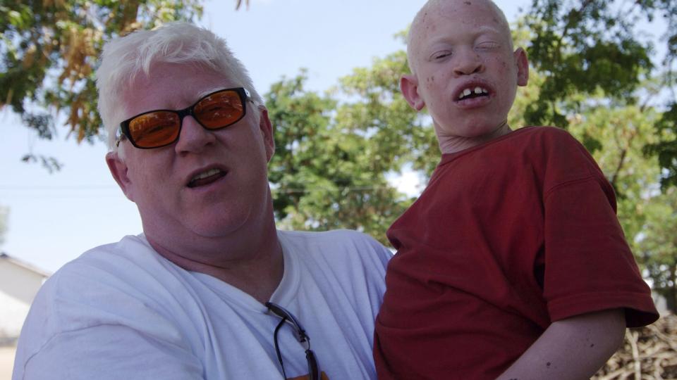 ANGRIPER BARN: Kanadiske Peter Ash, grunnleggeren av albinosmeforeningen Under the same sun, forteller at albinobarn er spesielt utsatt for � bli angrepet i afrikanske land fordi overtroen sier at desto mer uskyldig ofrene er, jo kraftigere blir heksebrygget. Flere albinobabyer er blitt drept like etter f�dselen, if�lge Ash. Her er han i Tanzania hvor han jobber for � hindre flere drap. FOTO: REUTERS/Katrina Manson
