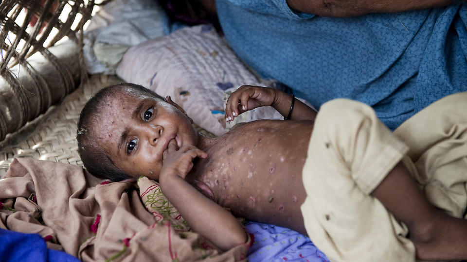 HUDSYKDOMMER: Under to senger som er satt opp mot hverandre ligger Rozianne Ali (2) i en teltkamp for flomofre utenfor Shikarpur i provinsen Sindh. Barn er hardt rammet av flomkatastrofen. Mange har utviklet diar� og alvorlige hudsykdommer p� grunn av d�rlige hygieniske forhold og mangel p� medisiner etter mer en to uker i leiren. De heldigste har f�tt et telt � bo i, men de fleste har bare det de fikk med seg da de r�mte fra hjemmene sine. Foto: Olav A. Saltbones/R�de Kors
