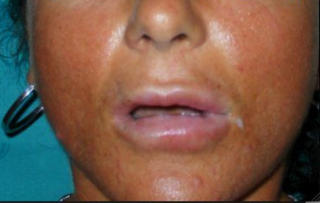 BOTOX: Kvinnen fikk �delagt leppene sine etter behandling med Botox. Foto: Domenico Stefania