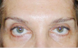 ASYMMETRISK: Denne pasienten hadde f�ttasymmetriske �yebryn etter injeksjoner med botox. Foto: Domenico Stefania
