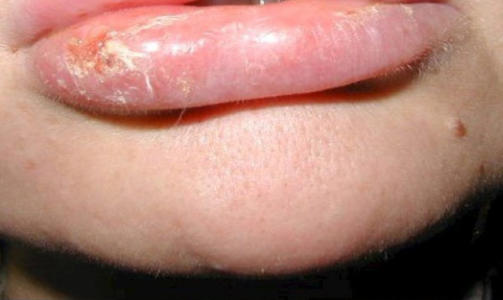 SKADET AV RESTYLANE: Mange kvinner opplever � f� oppsvulmede lepper med s�r etter feilbehandling med Restylane. Foto: Domenico Stefania