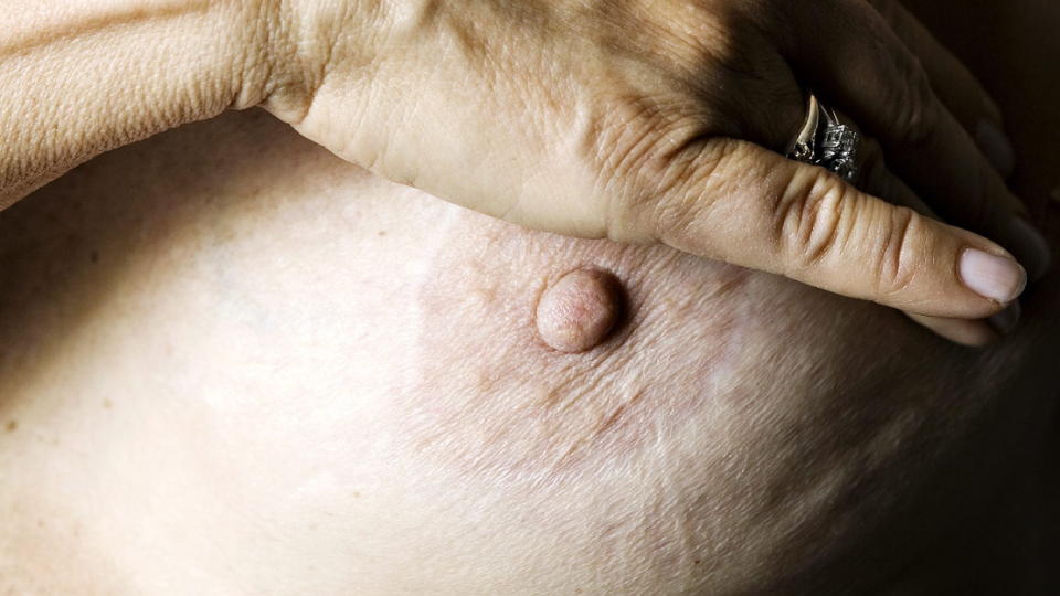 KREFTSJEKK: Her er Kreftforeningens tips til hvordan man sjekker brystene: 1. Liggende: Legg en pute under venstre skulder. Plassere venstre arm under hodet. Bruk hele h�nden eller to flate fingre, gjerne med hudkrem eller lotion. Kjenn systematisk gjennom venstre bryst med sm� sirkelbevegelser. Bruk lett eller middels press p� hvert omr�de av brystet. Gjenta p� h�yre bryst. 2. Foran speilet st�ende: L�ft armene over hodet. Se etter om uregelmessigheter vises i brystenes ytre form. Det merkes best n�r armene l�ftes opp eller mot siden. V�r obs p� hudforandringer som inndragninger eller misfarging. 3. I dusjen: L�ft venstre arm. Sjekk venstre bryst med s�pete, flate fingre. Unders�k brystet p� samme m�te som liggende. Gjenta p� h�yre bryst. Foto: NINA/HANSEN, Dagbladet