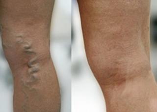 F�R OG ETTER: Tykke blod�rer som slynger seg oppover bena kan enkelt fjernes, og det finnes flere metoder. Kvinnen p� bildet har brukt laser. Foto: Sense Media