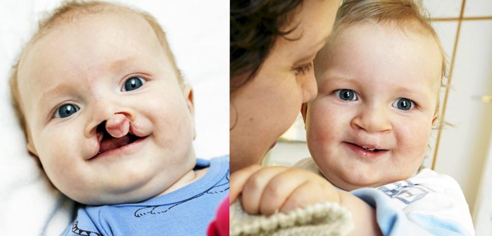 F�R OG ETTER: Lille Marius er blitt operert tre ganger, og om noen f� �r blir det enda flere. - Vi har en ekstra utfordring i � gj�re ham sterk, sier mamma Hanne. FOTO: Kjersti Gjems Vangberg