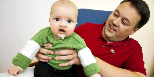 MARIUS OG PAPPA: Marius er blitt 5 m�neder. Etter den andre operasjonen f�r han skinner over albuleddet for � hindre ham i � ta p� s�ret. Pappa gir ham mat med en spesialflaske. FOTO: Kjersti Gjems Vangberg