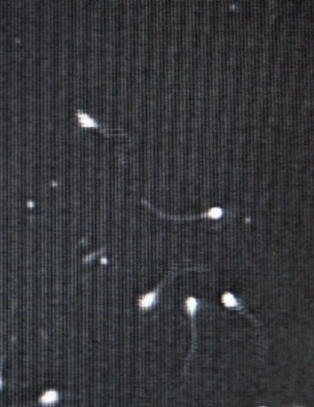 Helsedirektoratet vurderer gratis prevensjon