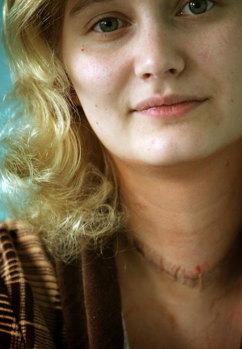 DE ALLER FLESTE OVERLEVDE: Bare en prosent av barna som fikk skjoldbruskkjertelkreft har s� langt d�dd av sykdommen, som lar seg behandle. Bildet viser en ukrainsk kvinne som ble utsatt for str�ling fra kjernekraftverket og fikk skjoldbruskkjertelkreft. Foto: REUTERS/Damir Sagolj
