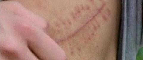 17-åring solgte nyra si for å få råd til en iPad