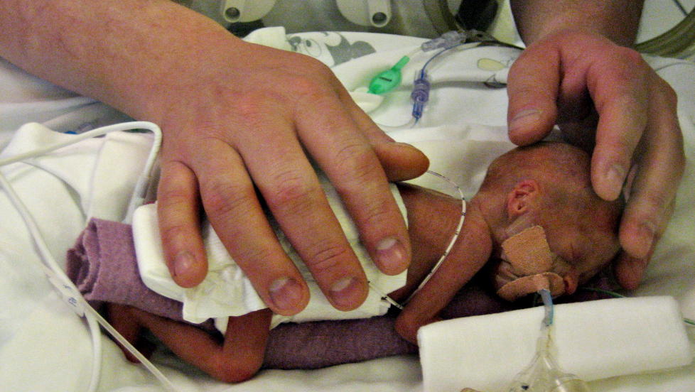 FOR TIDLIG: Lotte var et prematurt barn: f�dt s� tidlig som i uke 24. Her holder far rundt sin nyf�dte datter. Foto: privat