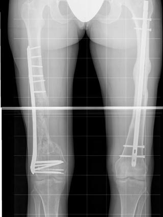 Bein i stål: I høyrebeinet har Karina fått erstattet bein med en 12 cm. lang jernskinne. Foto: Ullevål sykehus Bein i stål: I høyrebeinet har Karina fått erstattet bein med en 12 cm. lang jernskinne. Foto: Ullevål sykehus