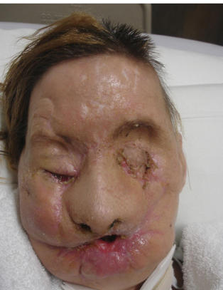 Fikk nytt ansikt etter grotesk sjimpanseangrep