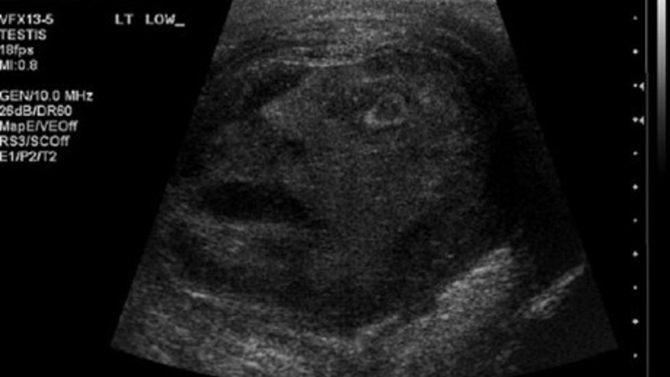 TITT TEI: Dette synet m�tte to urologer som unders�kte en 45 �r gammel mann for testikkelkreft. Foto: Clinical Urology