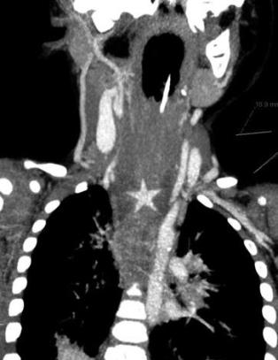 Her sitter julestjerna fast i halsen p� gutt (7 mnd)