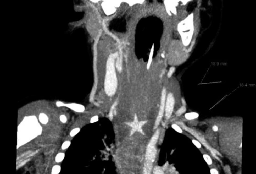  OVERRASKELSE : En CT-scan av guttens luftveisystem avsl�rte en plastikk-julestjerne i spiser�ret. Foto: Tidsskrift for den Norske Legeforening