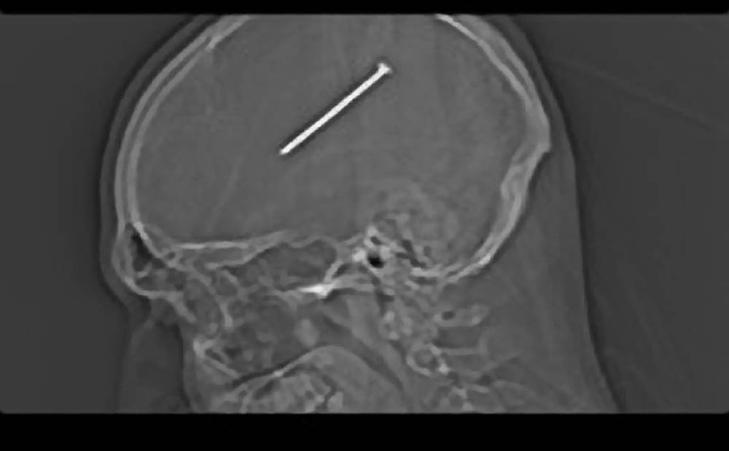 HER SITTER SPIKEREN: R�ntgenbildet viser at den 7,5 centimeter lange spikeren satt midt i Autullos hjerne. Foto: AP Photo/Christ Medical Center & Hope Children's Hospital