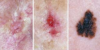 VANLIGST: De tre vanligste typene hudkreft er (f.v.) basalcellekarsinom, plateepitelkarsinom og f�flekkreft eller malignt melanom. Foto: Kreftforeningen.no