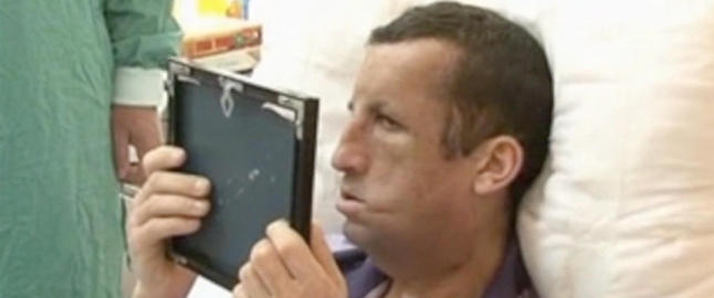 19 �r etter brannen som vansiret ham, fikk Ugur Acar i dag se sitt nye ansikt
