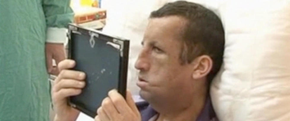 19 �r etter brannen som vansiret ham, fikk Ugur Acar i dag se sitt nye ansikt