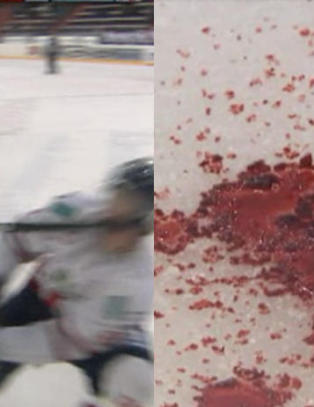 - Jeg har brudd i nesa, kjeven har flytta litt p� seg og jeg har et kutt over �yet