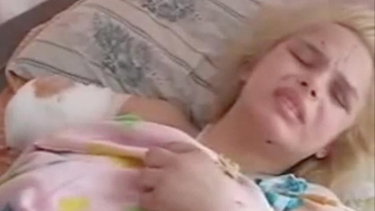 OMFATTENDE SKADER: Oksana hadde mistet huden på 55 prosent av kroppen. Hun måtte amputere en arm og begge føttene. Foto: YouTube OMFATTENDE SKADER: Oksana hadde mistet huden på 55 prosent av kroppen. Hun måtte amputere en arm og begge føttene. Foto: YouTube