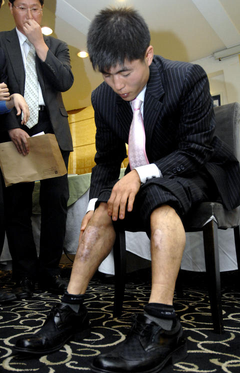 TORTURERT: Shin Dong-Hyuk er den eneste kjente personen som har klart å flykte fra en av totaltkontrollsonene i et nordkoreansk fengsel. Her viser han arrene han fikk da han rømte under en pressekonferanse i Seoul i 2007. Foto: AFP PHOTO/JUNG YEON-JEFoto: AFP PHOTO/JUNG YEON-JE TORTURERT: Shin Dong-Hyuk er den eneste kjente personen som har klart å flykte fra en av totaltkontrollsonene i et nordkoreansk fengsel. Her viser han arrene han fikk da han rømte under en pressekonferanse i Seoul i 2007. Foto: AFP PHOTO/JUNG YEON-JEFoto: AFP PHOTO/JUNG YEON-JE