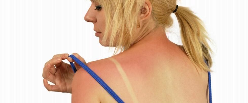 Har du først blitt brent, er det særlig fem ting som hjelper