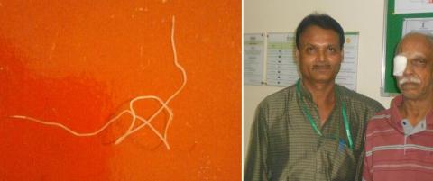 Hadde 12,5 centimeter lang, levende orm bak �yet