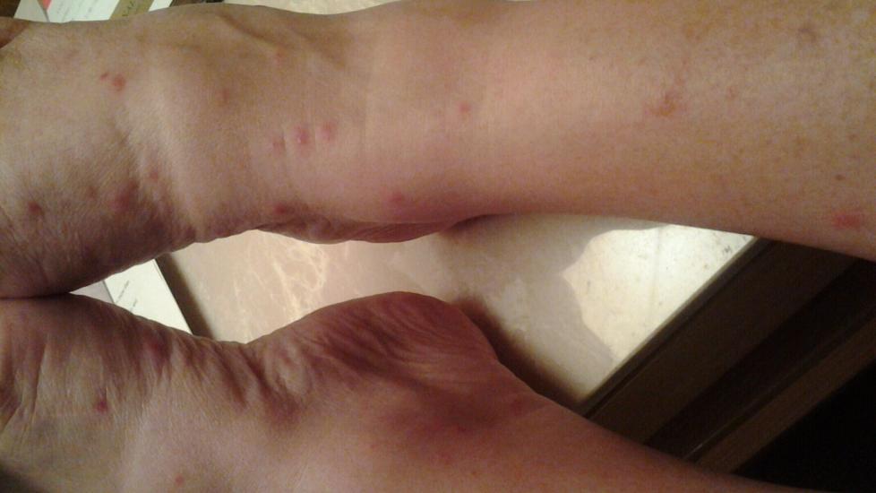 BITT I THAILAND: Over et par dager i Thailand fikk Berit flere bitt som ga kl�ende, v�skende utslett p� bein og armer. Foto: PRIVAT