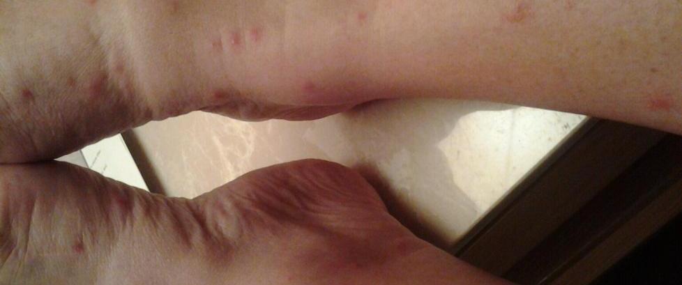 Bittene ga kl�ende, v�skende utslett, og kom i l�pet av noen dager