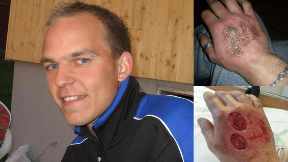 ETSESKADET H�ND:  En steikeovnsvask endte med d�d hud og hudtransplantasjon for John Rune Antonsen fra Bod�. Bildet �verst til h�yre er tatt rett etter at han hadde vasket ovnen, mens bildet nederst viser h�nda etter at legene hadde fjernet den d�de huden. Foto: Privat