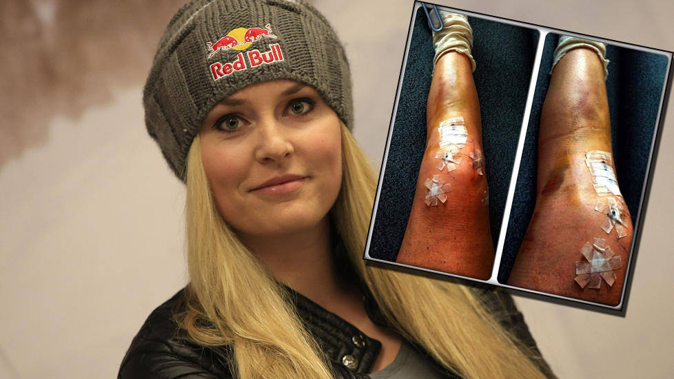 FALT STYGT: Lindey Vonn falt stygt under �pningsrennet i alpin-VM. N� har hun operert kneet og ser fram mot en sommer uten kort kj�rt. Foto: Afp Photo, Lindsey Vonns instagram.