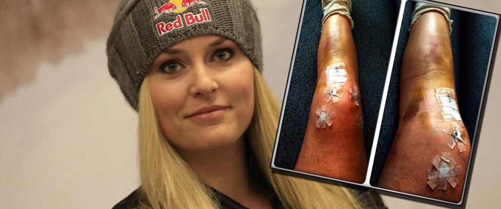 Derfor dropper Lindsey Vonn kort skj�rt i sommer