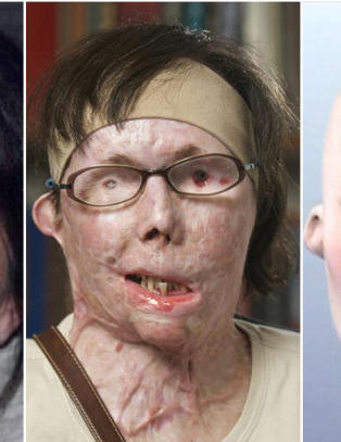 I 2007 dynket eks-mannen Carmen (44) i lut, nå har hun endelig fått sitt nye ansikt