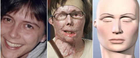 I 2007 dynket eks-mannen Carmen (44) i lut, nå har hun endelig fått sitt nye ansikt