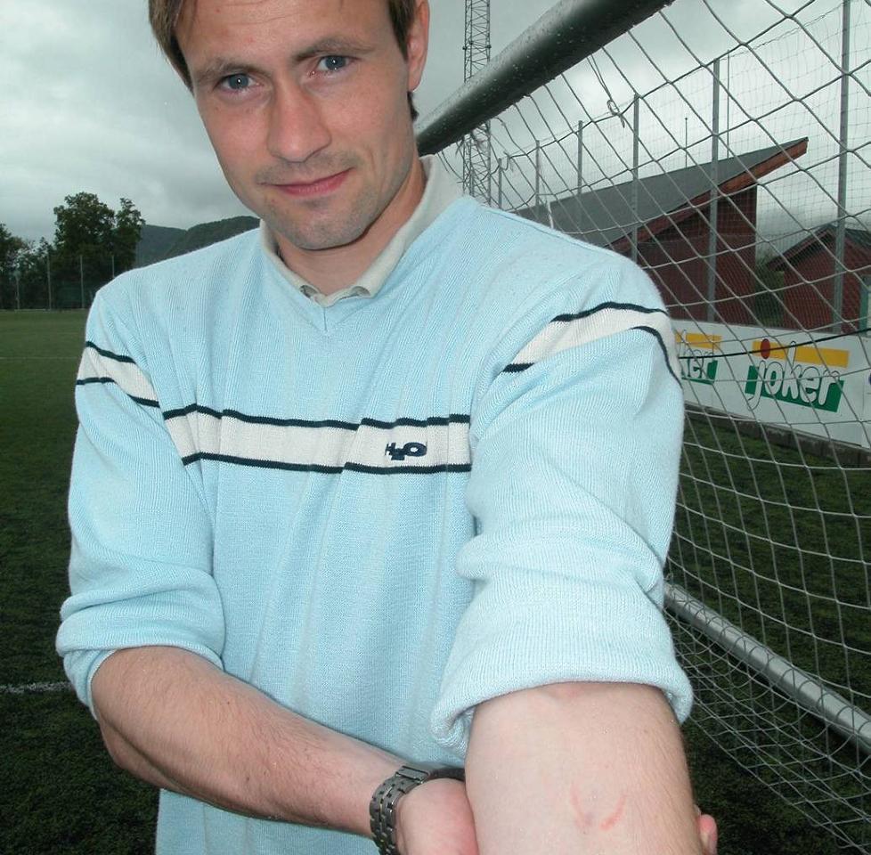 TYDELIGE MERKER: Kim Erik Deinoff etter bittet i 2004. Foto: Arnfinn Mauren / Aftenposten / NTB scanpix