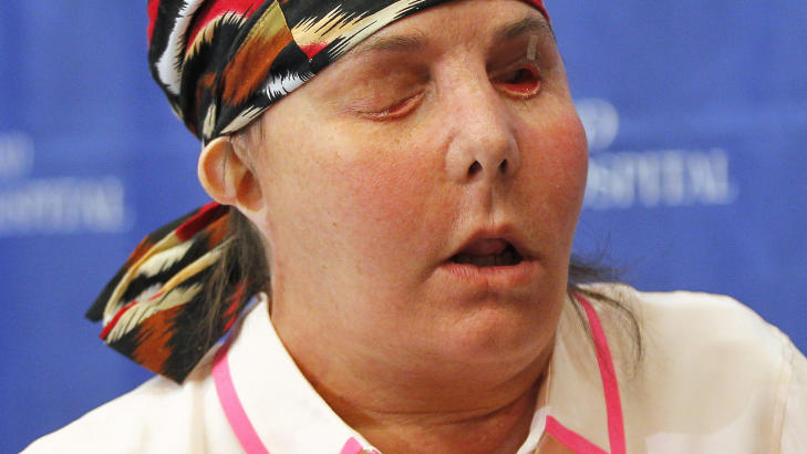 TO M�NEDER SIDEN: Det var i slutten av februar i �r at over 30 kirurger, anestesileger og sykepleiere brukte 15 timer p� � erstatte hud, muskler, sener og nerver hos Carmen. Hun har f�tt nytt ansikt, takket v�re donoren Cheryl Danelli-Righter. Foto: Reuters / Jessica Rinaldi / NTB Scanpix