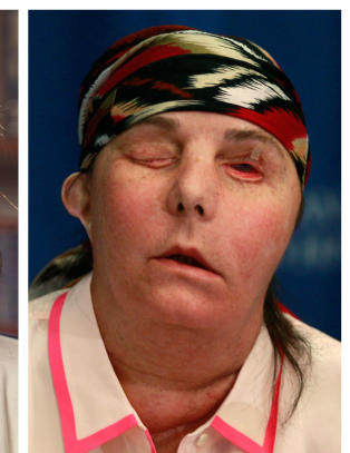 Slik ser skrekkens ansikt ut i dag, seks �r etter ektemannen angrep Carmen (44) med lut