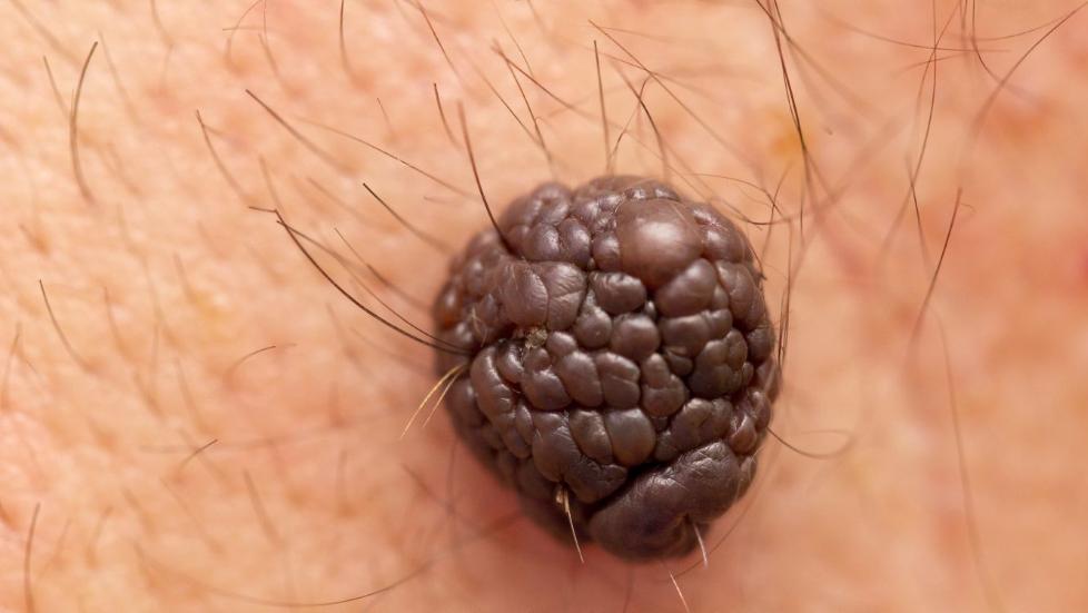 KREFT P� RYGGEN: For menn er det vanligst � f� f�flekkreft p� ryggen.  ILLUSTRASJONSFOTO: colourbox.no