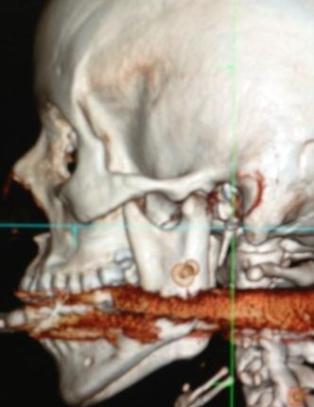 Elisangela (28) kommer trolig fra dette uten varige m�n