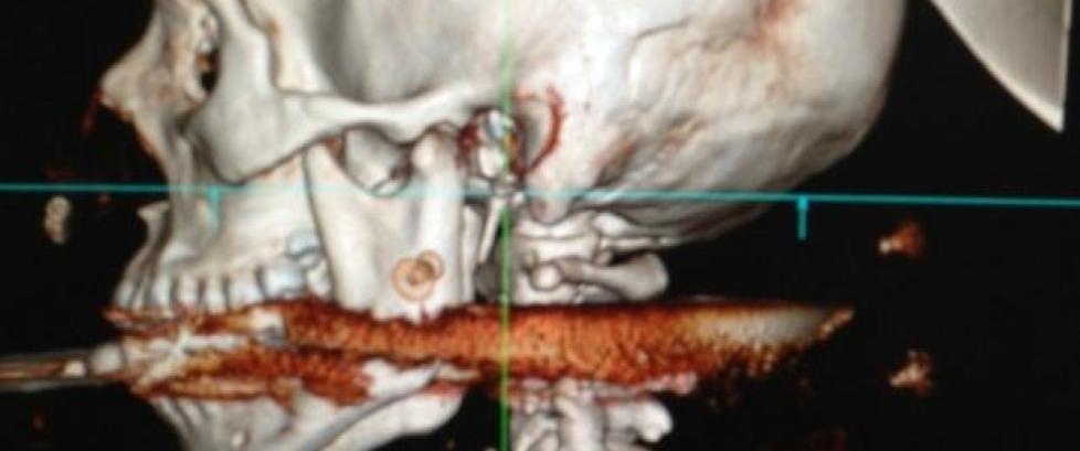 Elisangela (28) kommer trolig fra dette uten varige m�n