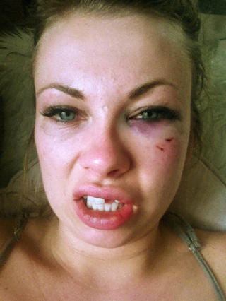 MISTET TANN: Carolines venstre fortann knakk rett av ved rota. N� venter opptil et �r med midlertidig tannprotese og regulering f�r hun f�r permanent tannerstatning. Foto: PRIVAT