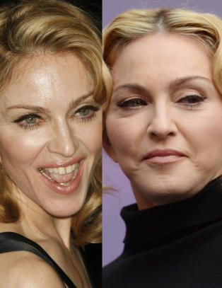 - Hun kan ikke nekte for � bruke botox